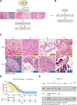 Transcriptome analyses reveal new insights on key determinants of perineural invasion in high-grade serous ovarian cancer